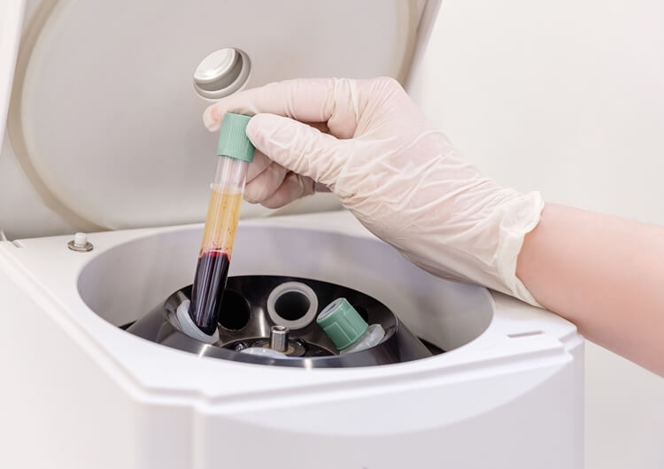 Plasma Separation in Blood Processing
